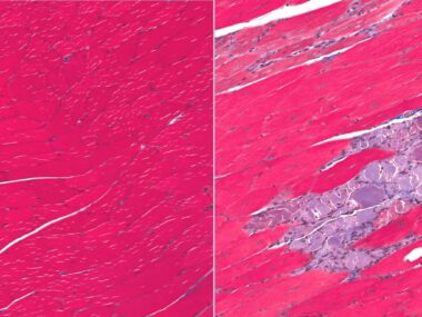 Muscle breakdown in SMA