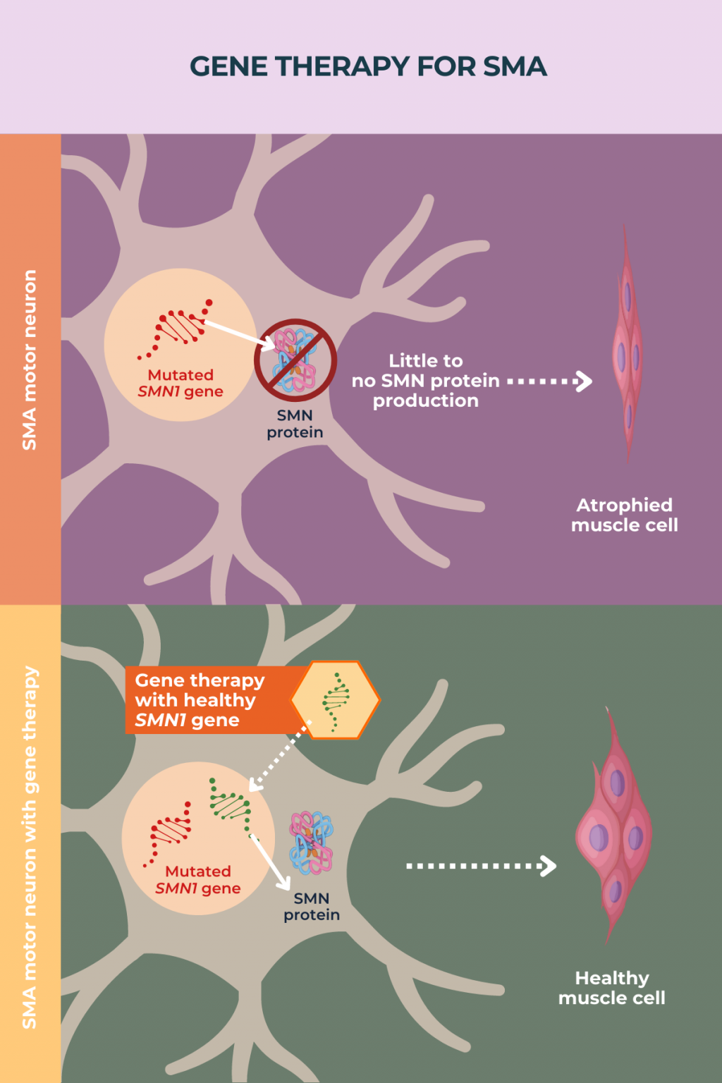 SMA gene therapy | SMA News Today