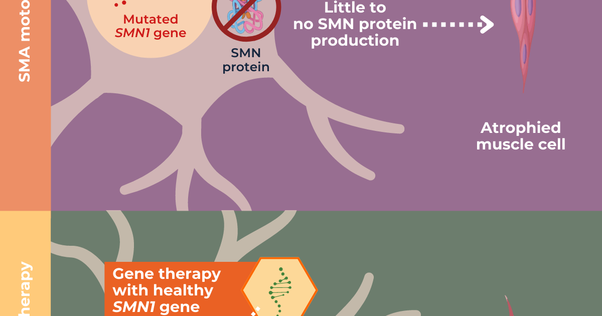 SMA Gene Therapy | SMA News Today