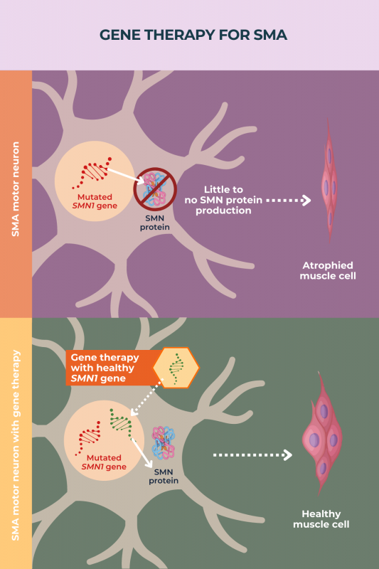 infographic depicting gene therapy for SMA