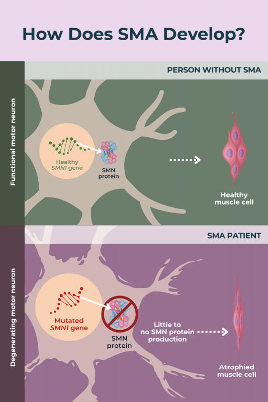 SMA overview | SMA News Today | Infographic showing how SMA develops