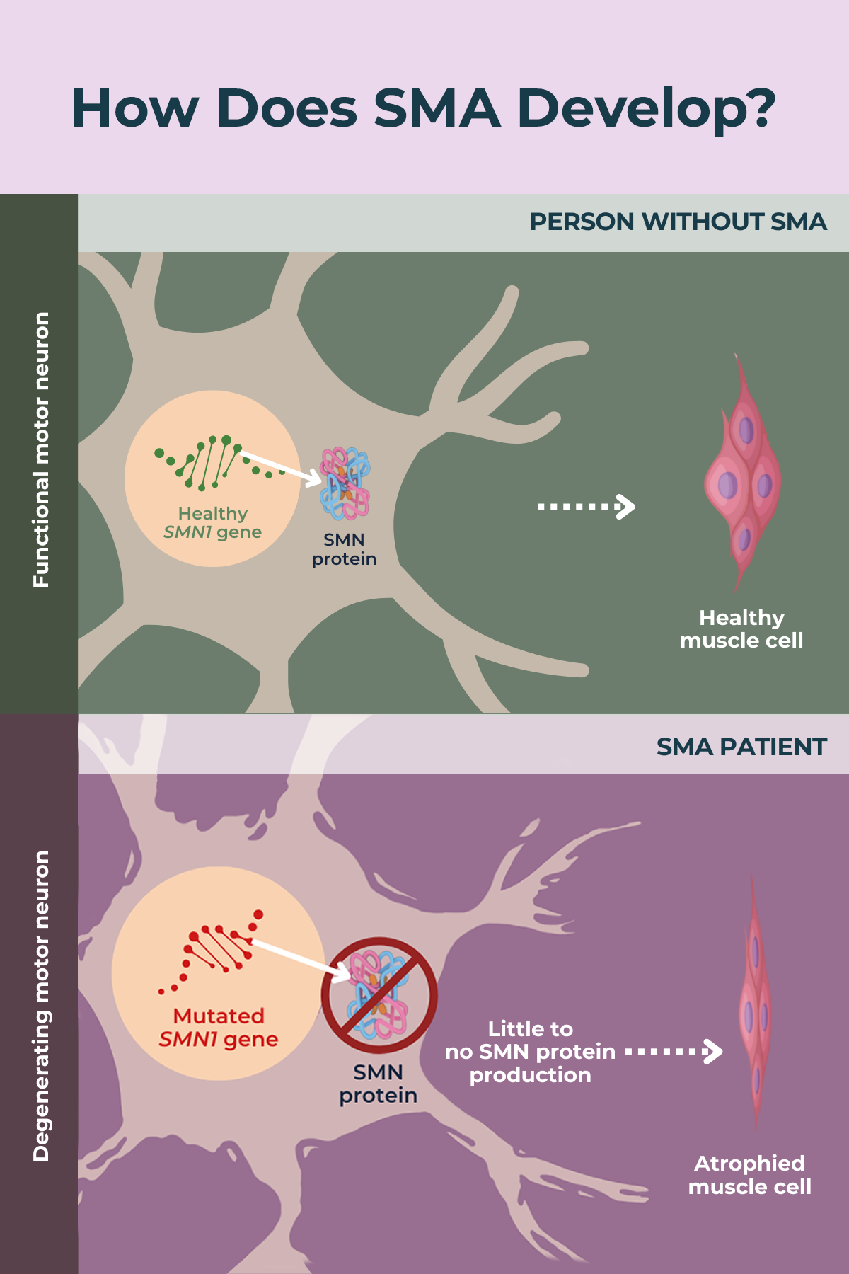 Spinal muscular atrophy (SMA) overview SMA News Today