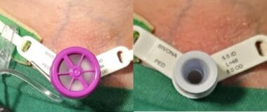 Two side-by-side images show a close-up of the author's tracheostomy. In one of the photos, there's a purple valve resembling a wheel secured on the hub of the trach.